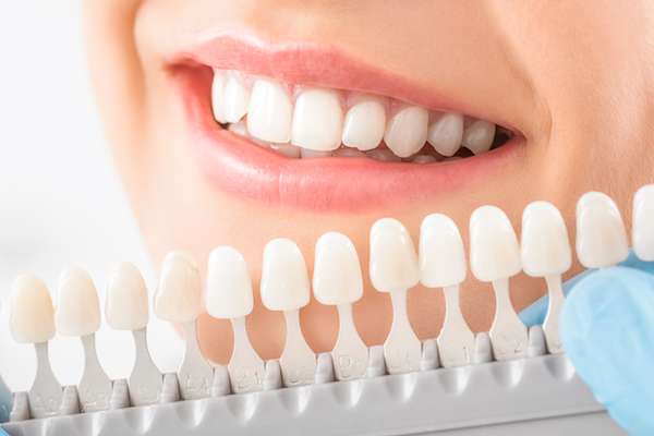 How Long Do Veneers Last? Tips For Maintaining Your New Smile